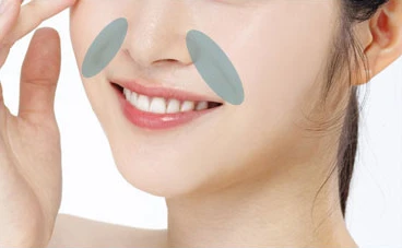 팔자필러 시술 부위